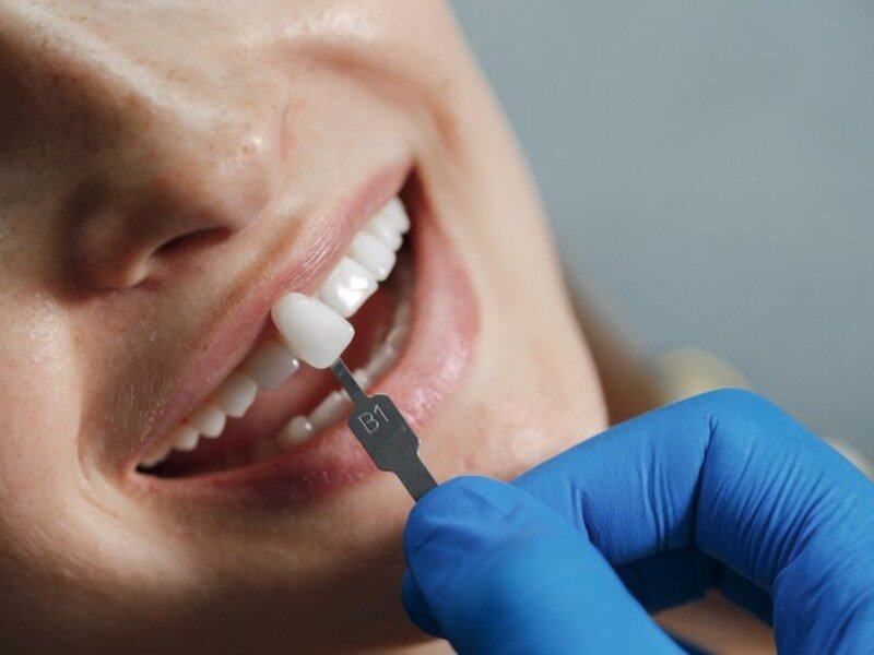 Professional dental cleaning at Smile Center