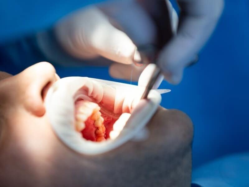 Aligners in Islamabad Smile Center Islamabad 3